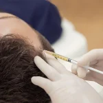 PRP for Hair Loss: Does It Work, and Who Does It Actually Suit?