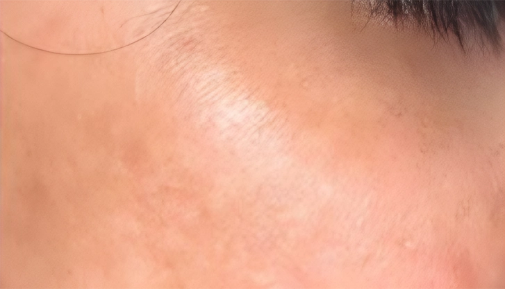 Refined skin texture after a carbon laser peel