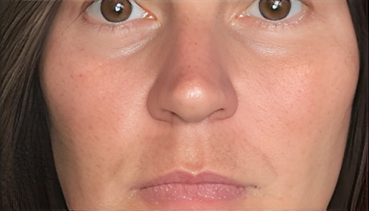 More even skin tone after a carbon laser peel