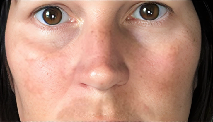 Uneven skin tone before a carbon laser peel