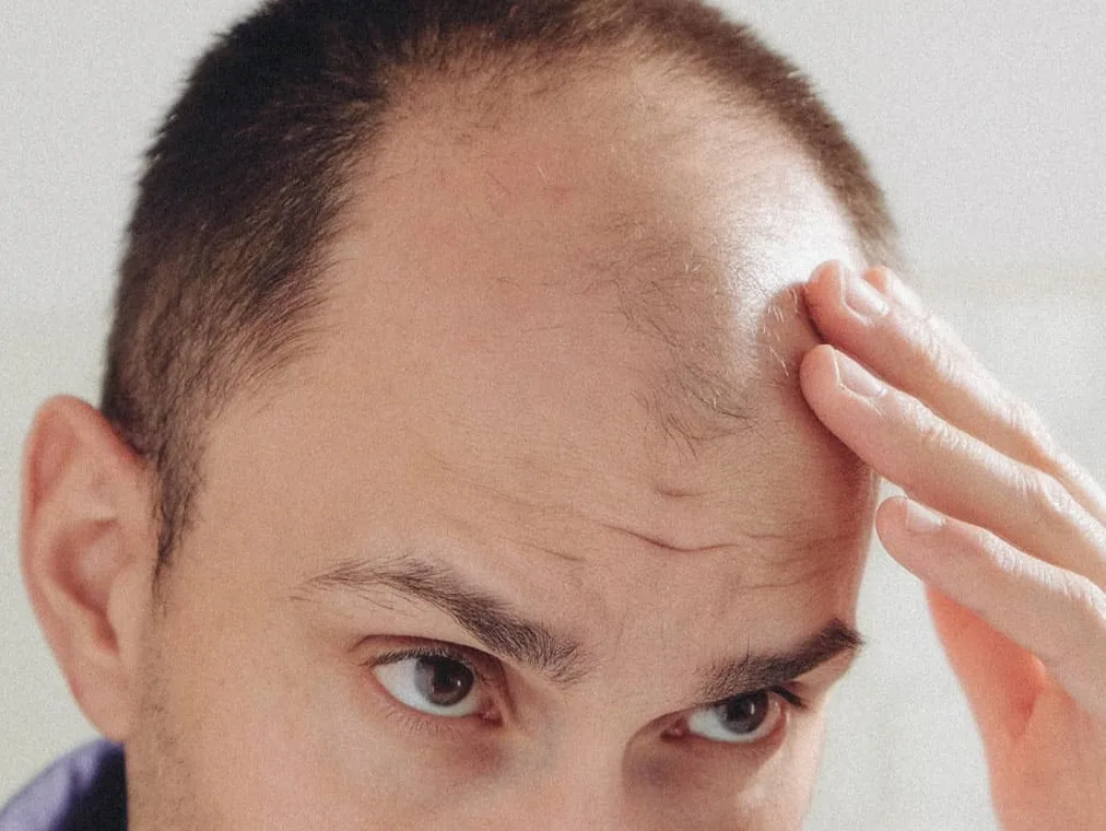 Hair Loss