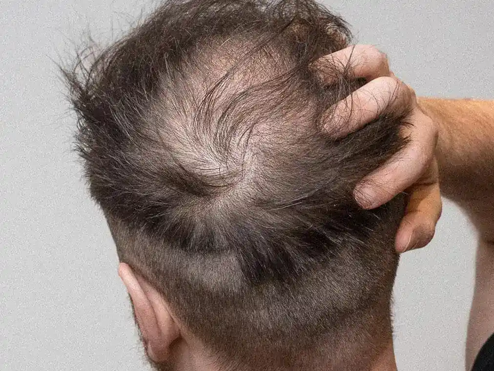 Hair Thinning