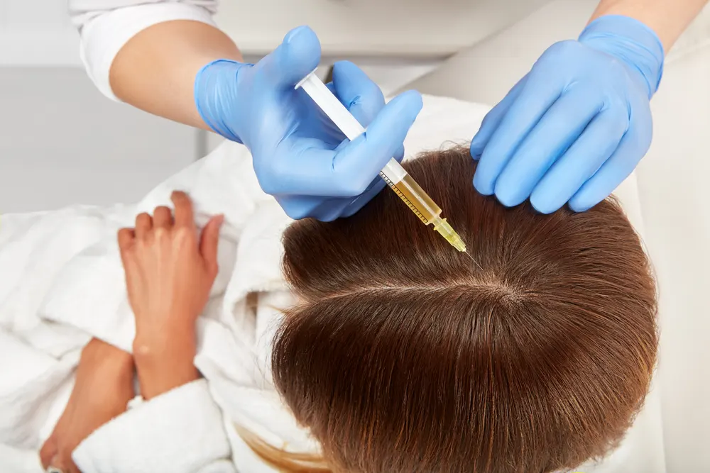 Is PRP Hair Treatment Permanent?